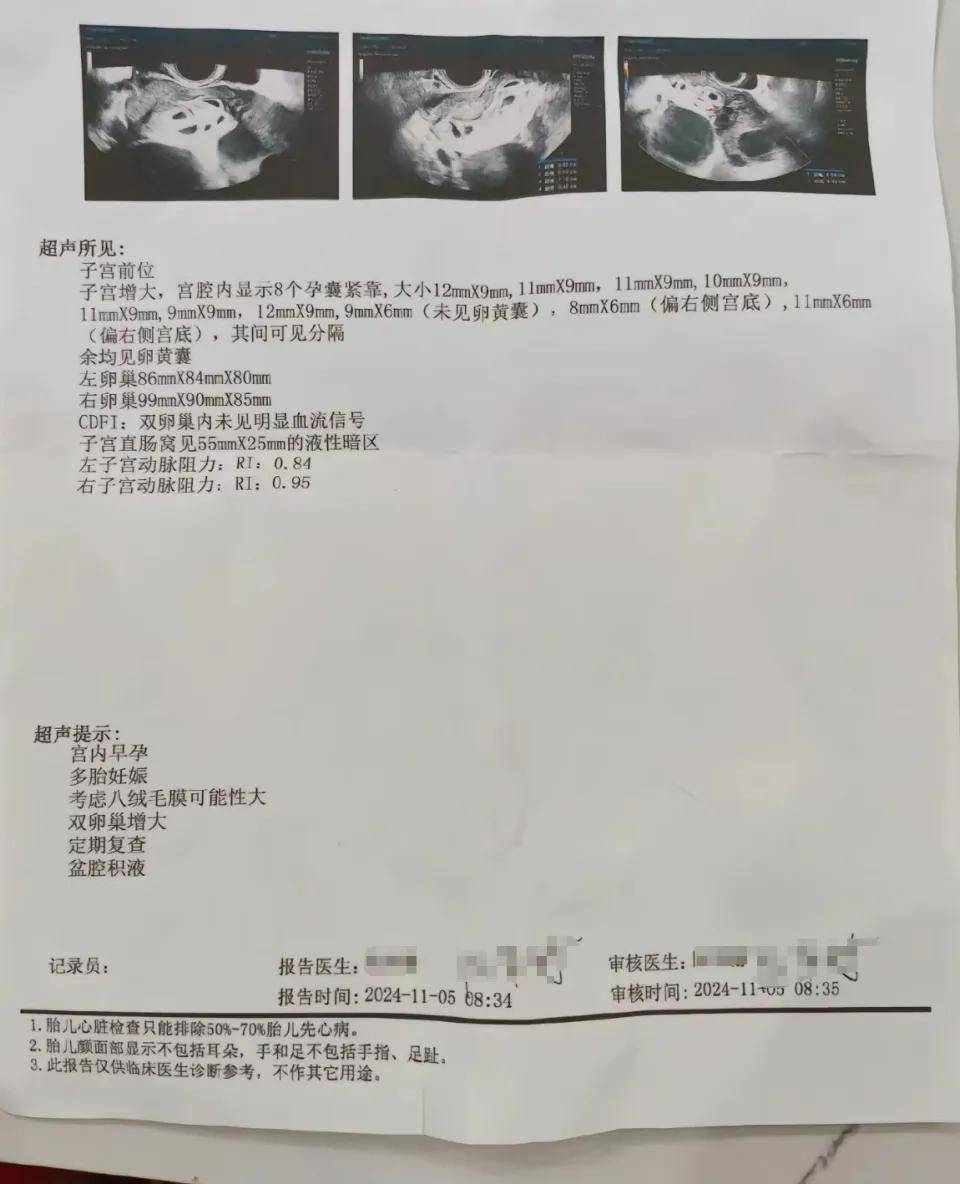 再次来到医院进行复查,没想到的是,检查结果宫腔内显示9个孕囊紧靠