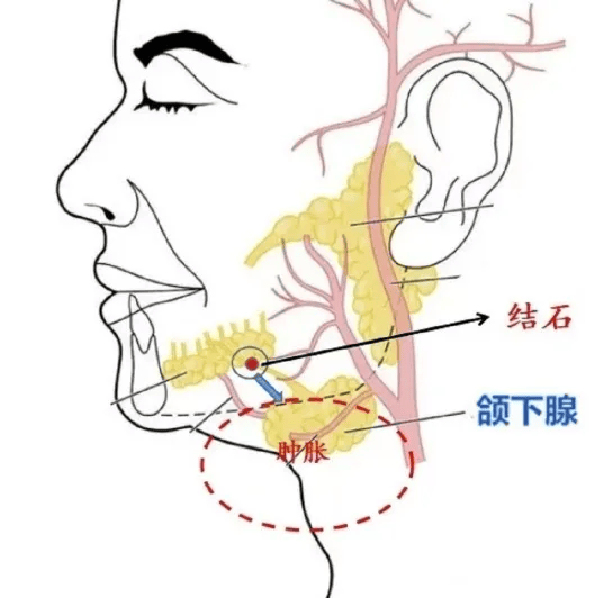 创新突破青岛西海岸新区中心医院成功实施首例内镜辅助微创颌下腺导管