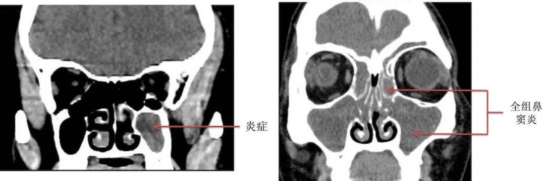 肠窦炎图片