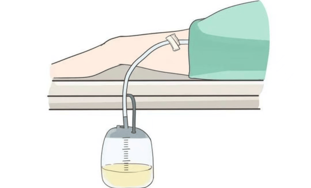 如何做好长期"留置导尿"患者的居家护理?