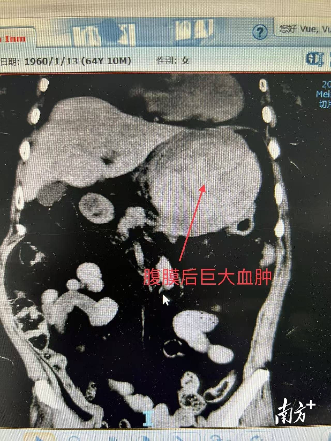 情况紧急！广州中医药大学梅州医院医务人员通力合作成功救治一马来西亚华侨