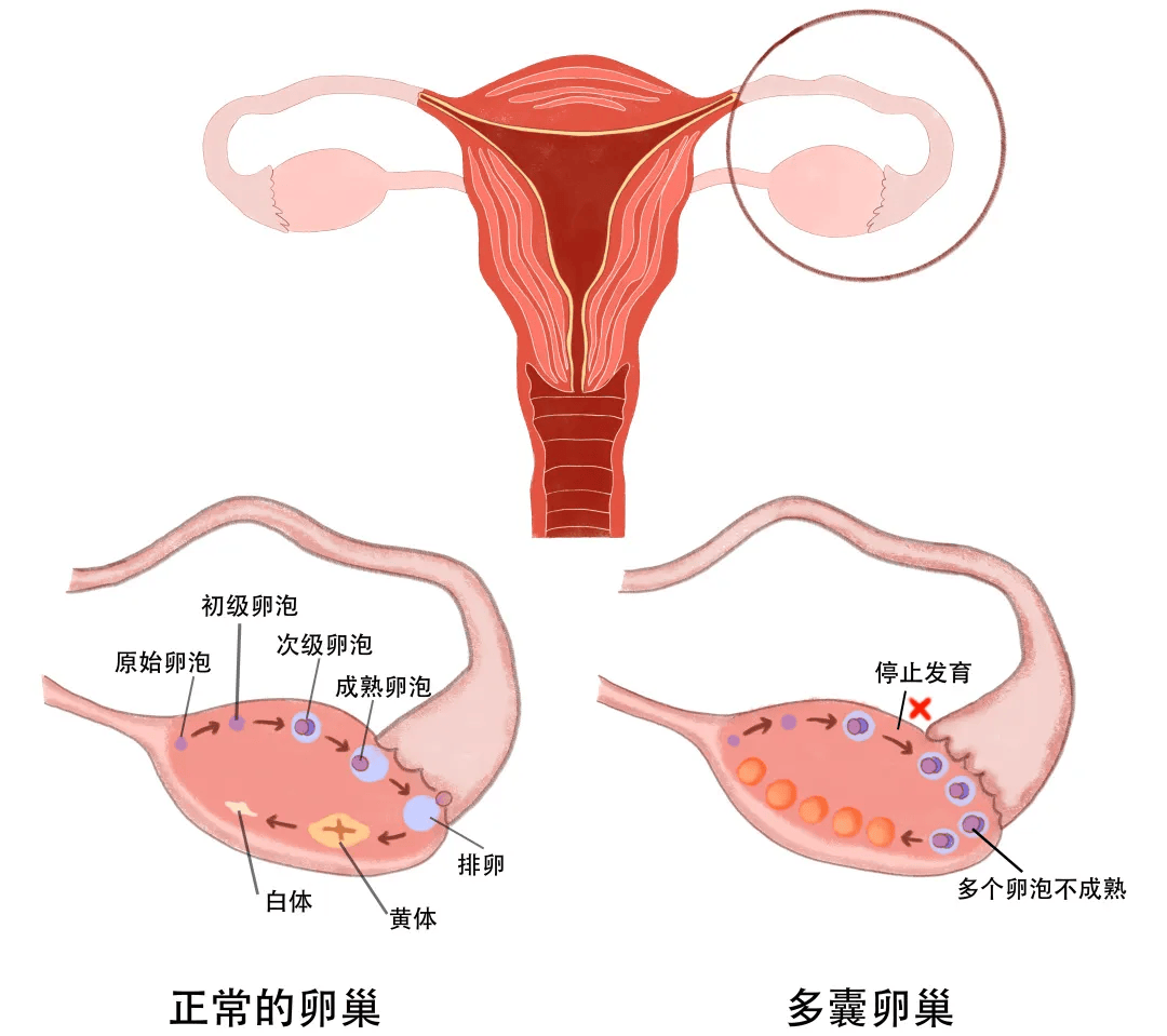 卵巢囊肿是气出来的吗