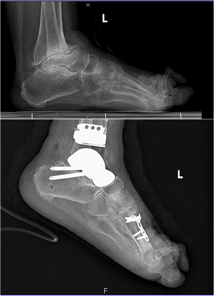 贵州首例!贵医附院成功实施3d打印全距骨假体伴人工全踝关节置换术