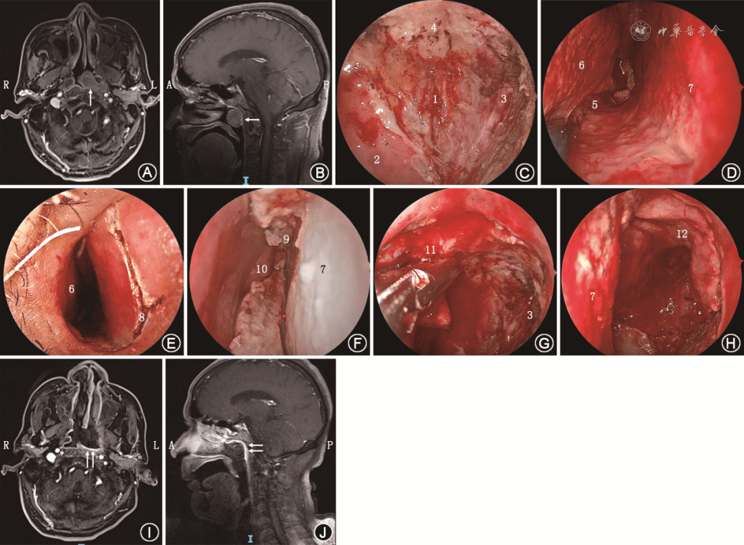 短篇论著 | 带蒂鼻中隔黏膜瓣静脉系统的解剖学研究及其在鼻颅底修复