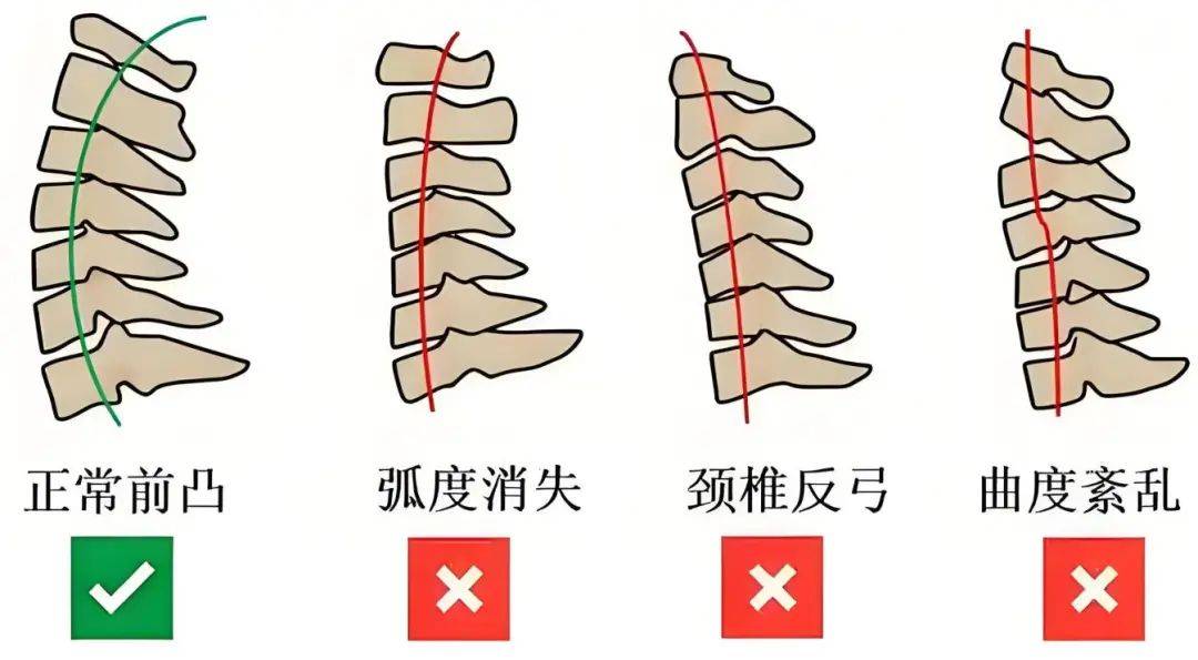 好好的颈椎,怎么就"反了"?