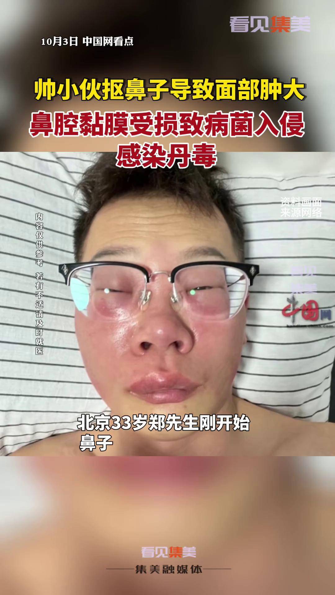 近日北京小伙称因长期抠鼻子感染丹毒健康科普