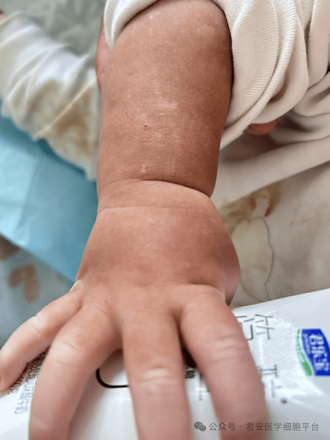 【病例分享】chédiak - higashi 综合征