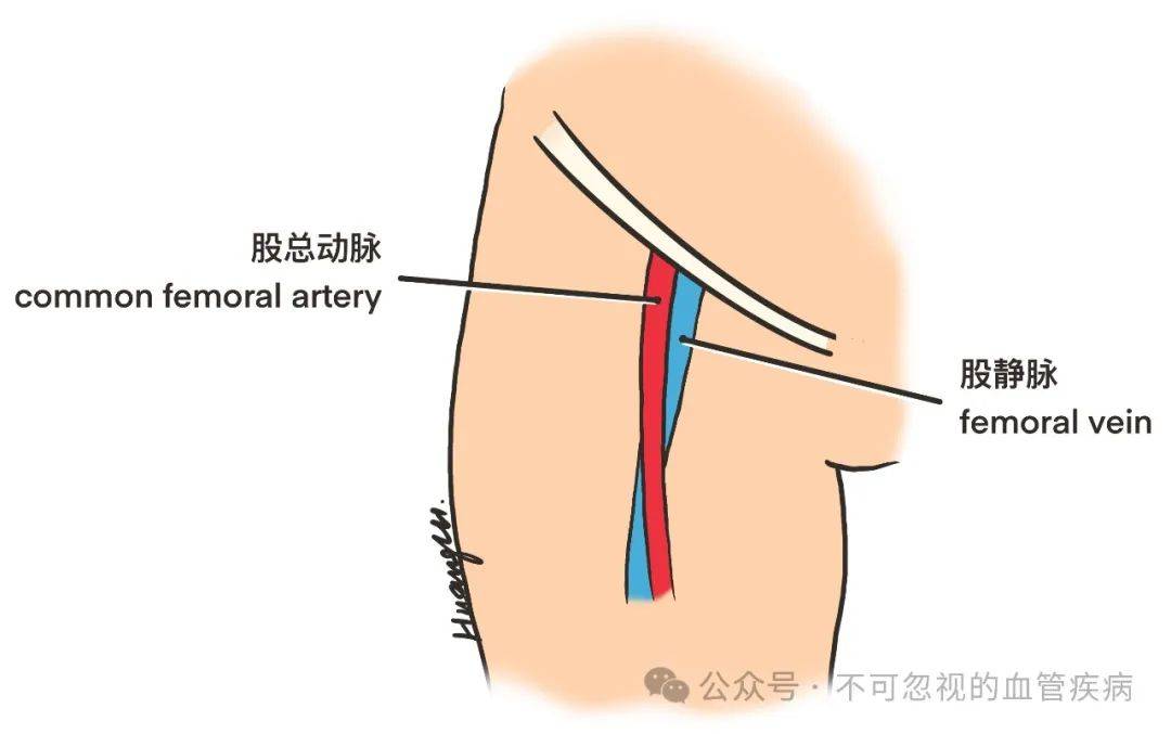 3%),然后股静脉从股动脉的下方逐渐往股动脉的外侧移行,在股三角的