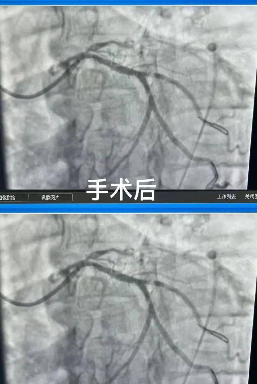 回旋支PCI术图片