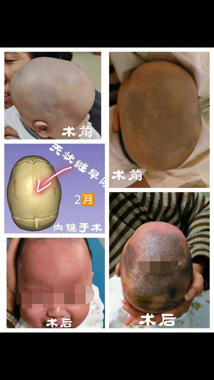 矢状缝早闭 内镜手术全流程,希望每个小朋友都健康