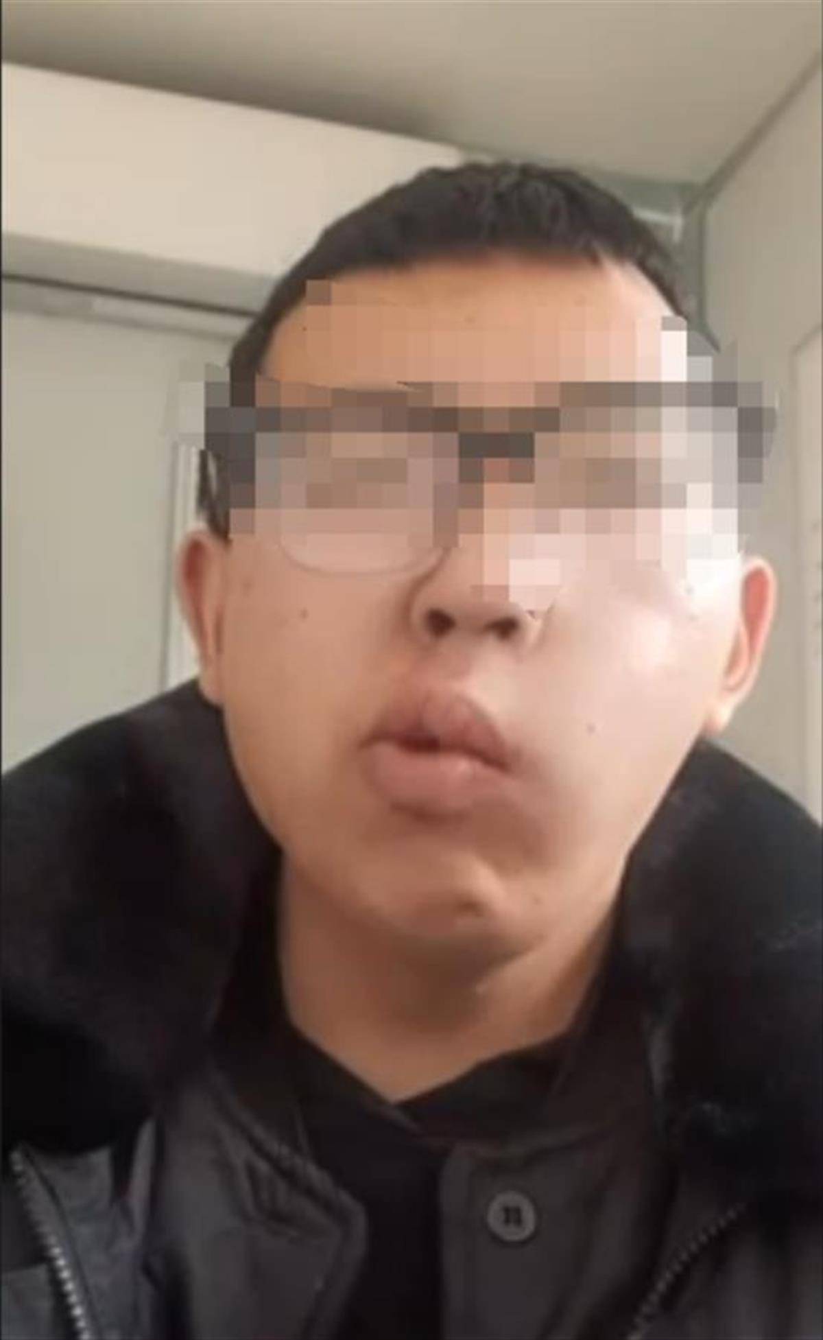 帅小伙嚼槟榔多年后眼歪嘴斜，当事人：现在找工作困难，希望大家引以为戒