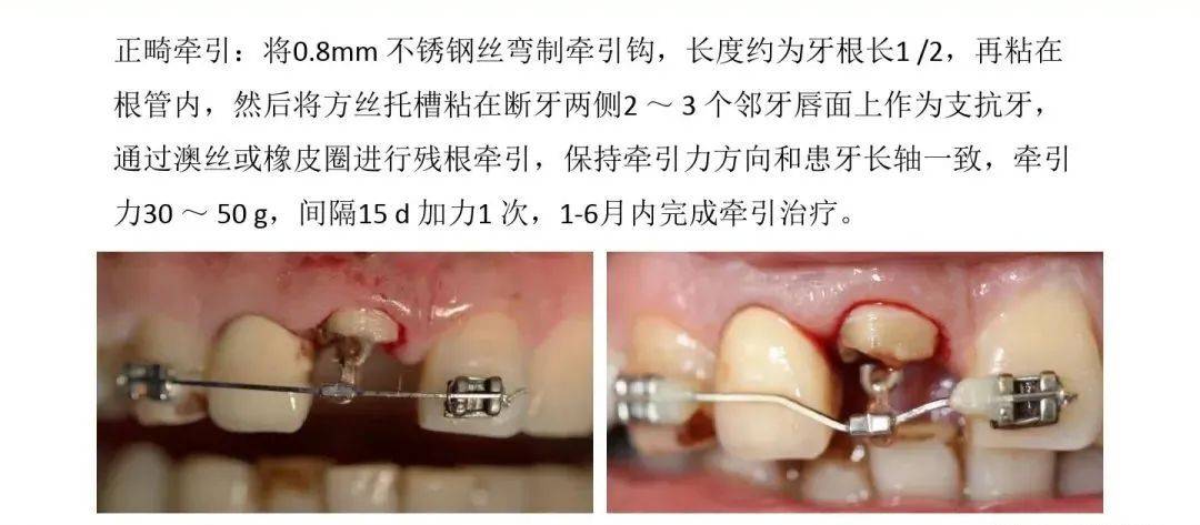 冠延长术的图解图片