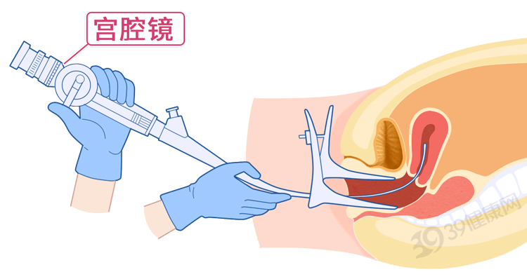 调或异常出血症状时，应定期进行妇科检查，必要时做宫腔镜或超声检查。