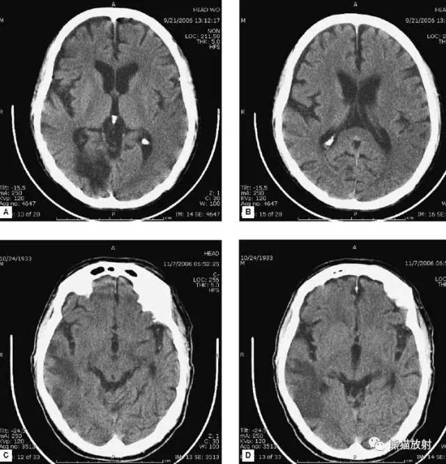 收藏超详细的头部ct读片详解