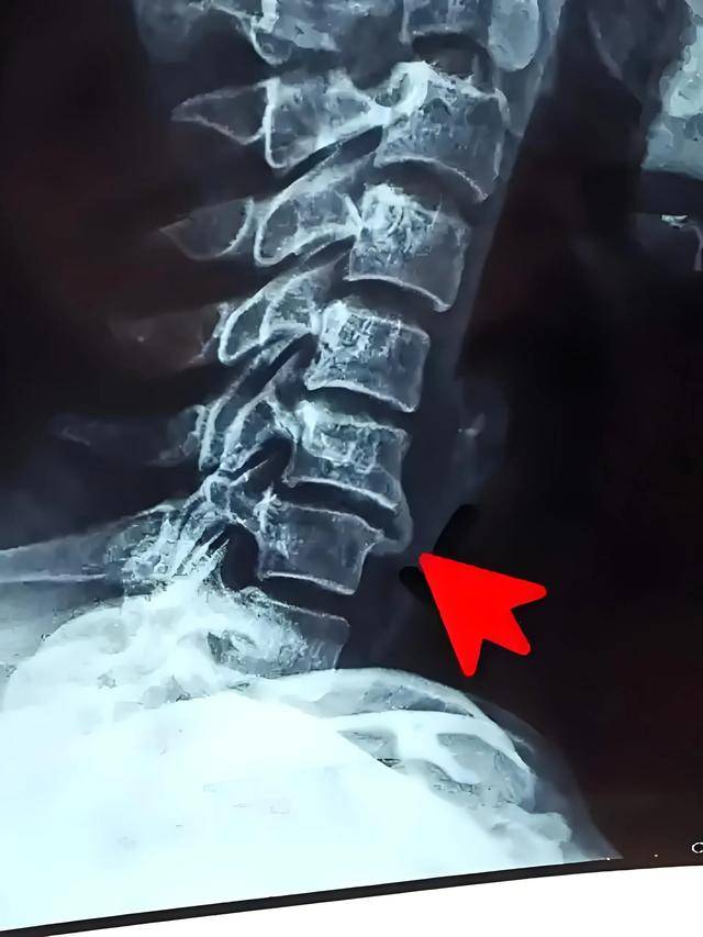 著名中医学家关幼波先生专门治疗骨质增生引起的疼痛麻木的经验方