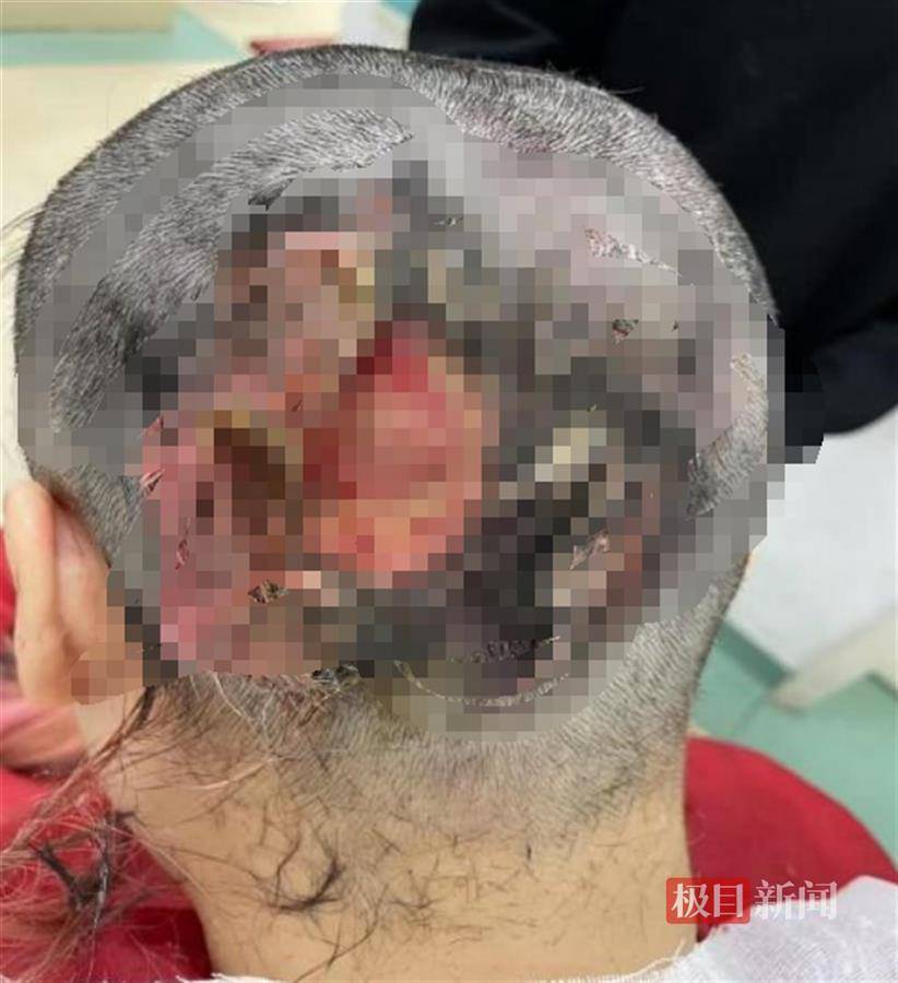 女子头皮严重烫伤,竟跟烫发有关,医生提醒!