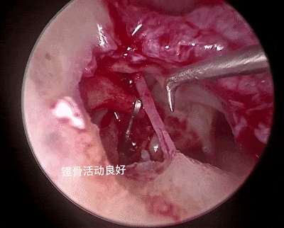 镫骨活动良好薛海翔团队制定了详细的手术方案和应急预案,2月初