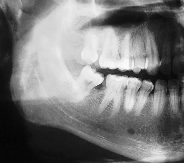 看牙医拍x光您需要担心辐射问题吗