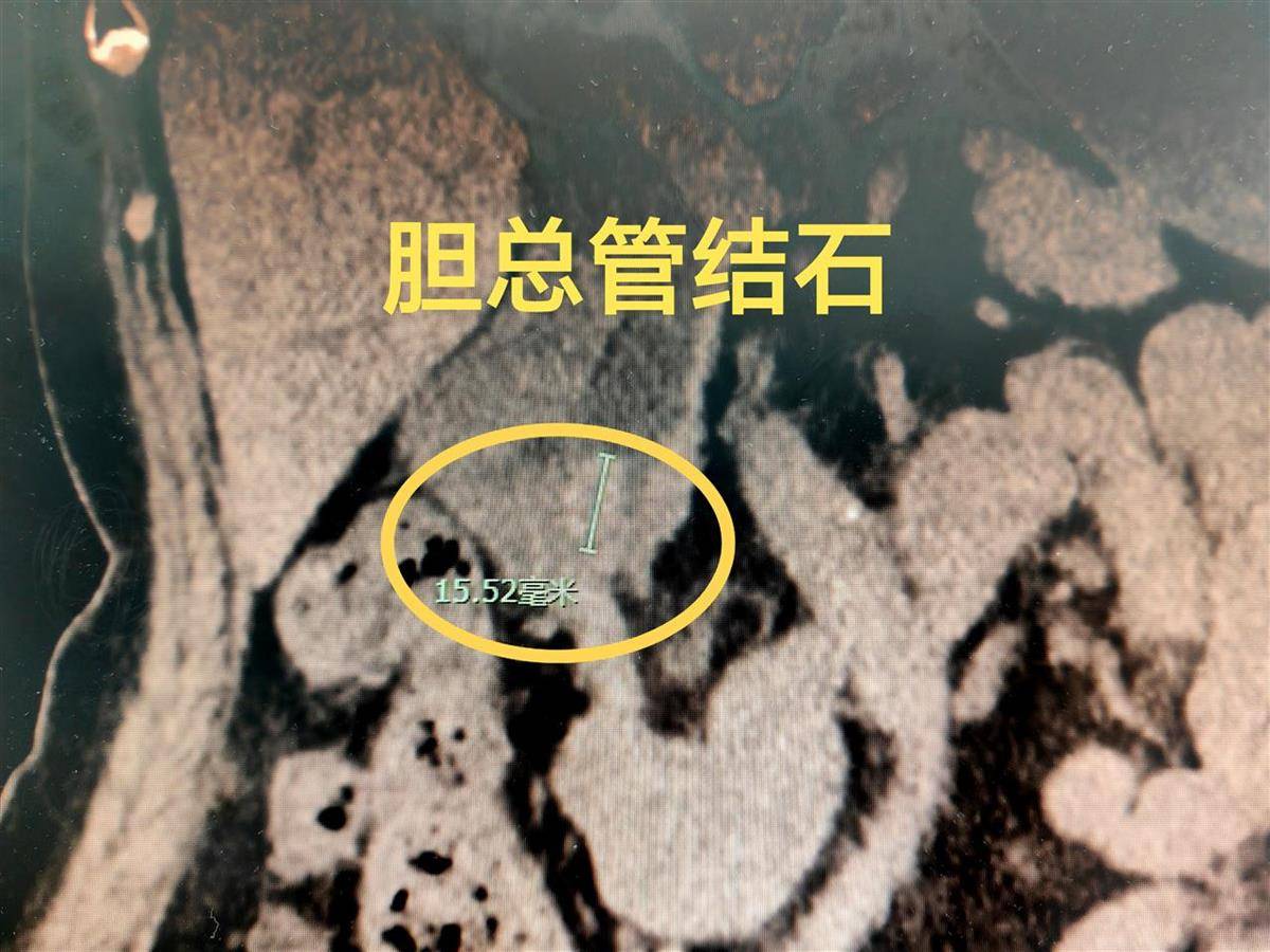 93岁婆婆胆管结石引发高烧腹痛"警报",医生妙用微创ercp技术"精准拆弹