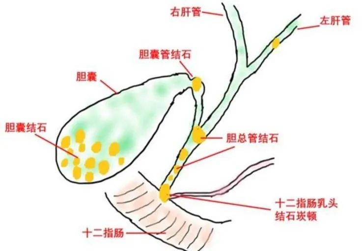 “ERCP”为九旬老人“探囊取物”_胆管_诊断_治疗