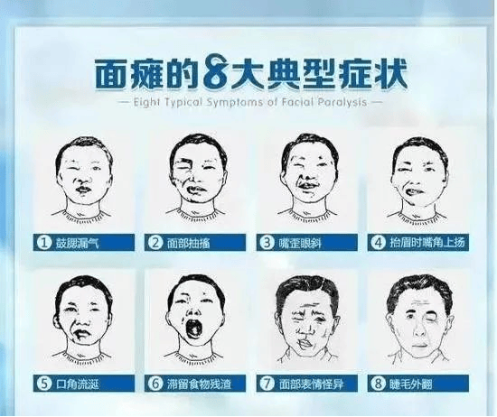 特发性面神经麻痹:深入认识"面瘫",科学有效应对