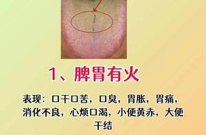 舌裂暗藏健康密码?4种常见裂纹舌,寿命长短早知道!