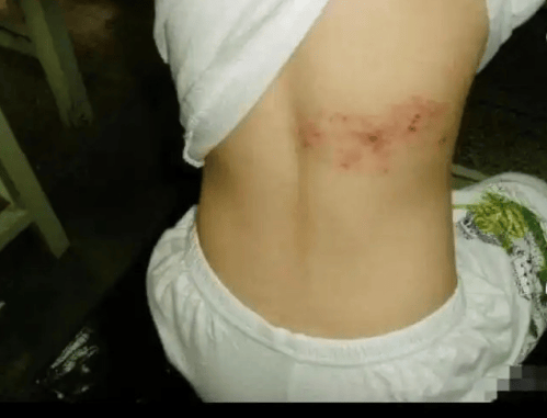 俗称"蛇缠腰":丁集人中老年人要注意了