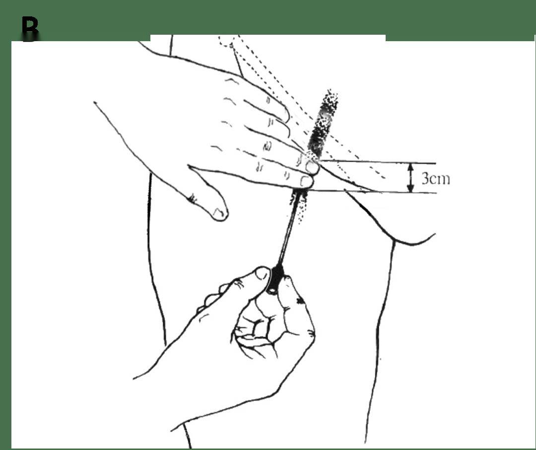 股动脉穿刺方法与技巧