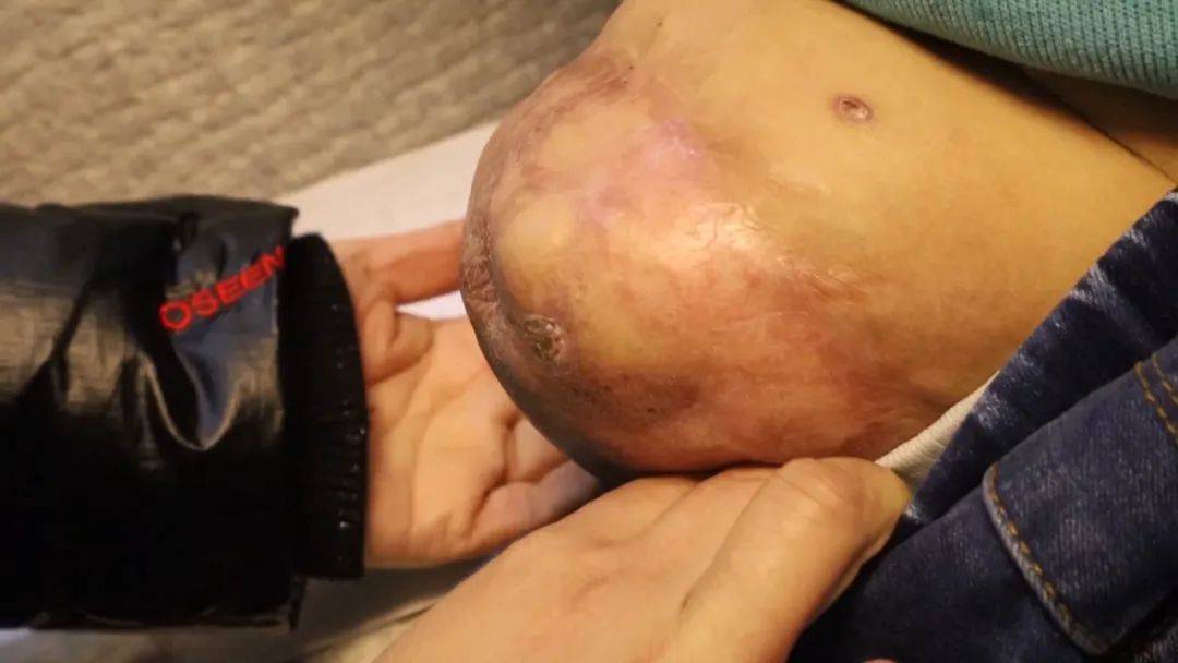 十二年前车祸截肢的小女孩,在妈妈的爱里长出了