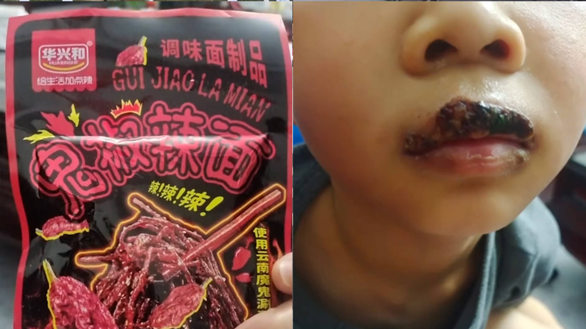 男孩因食用"爆辣"辣条,嘴唇起泡还结黑痂!只能吃流食