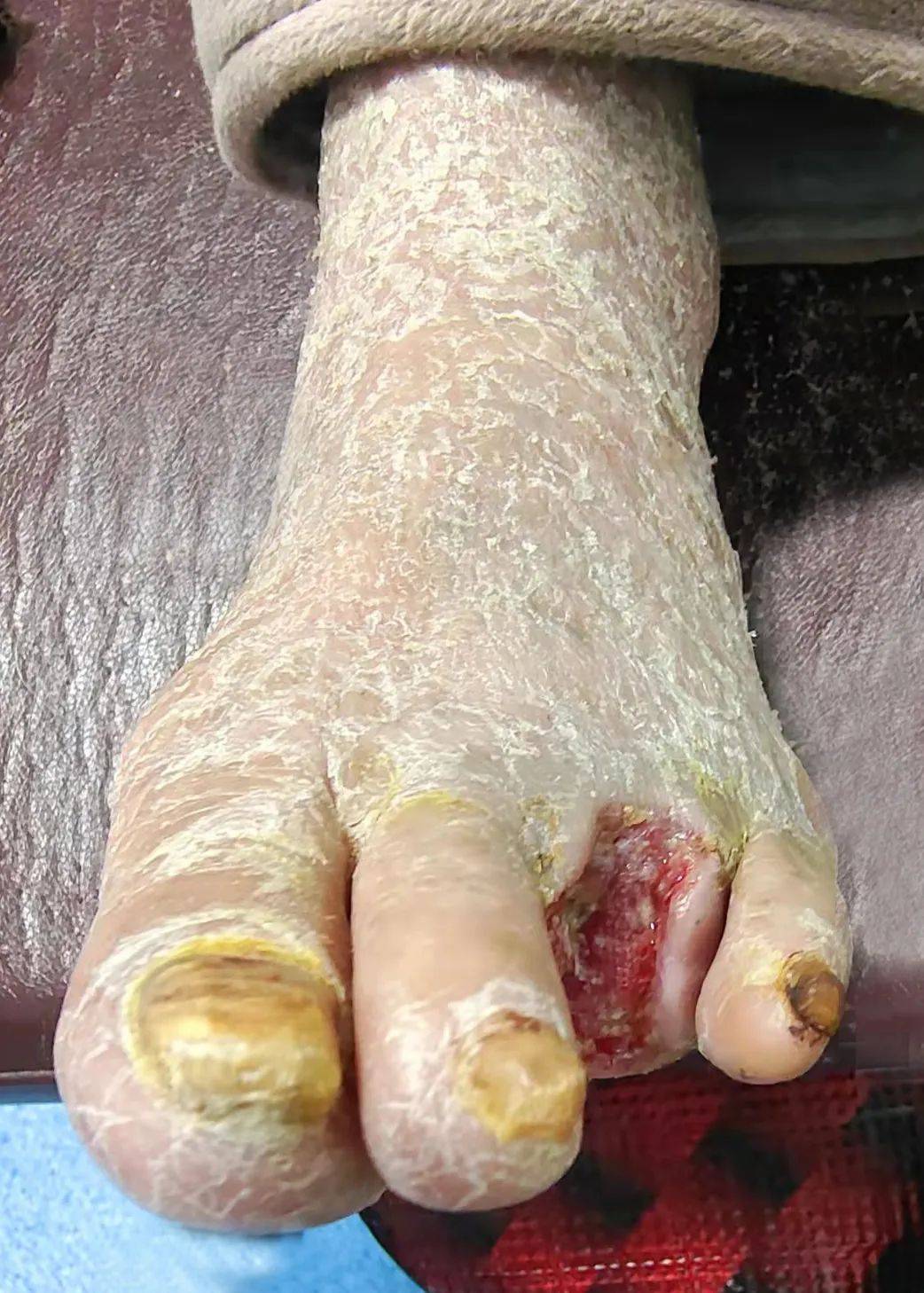 展播第四期】大庆市第四医院开展特色技术为糖尿病足坏疽患者保肢治疗