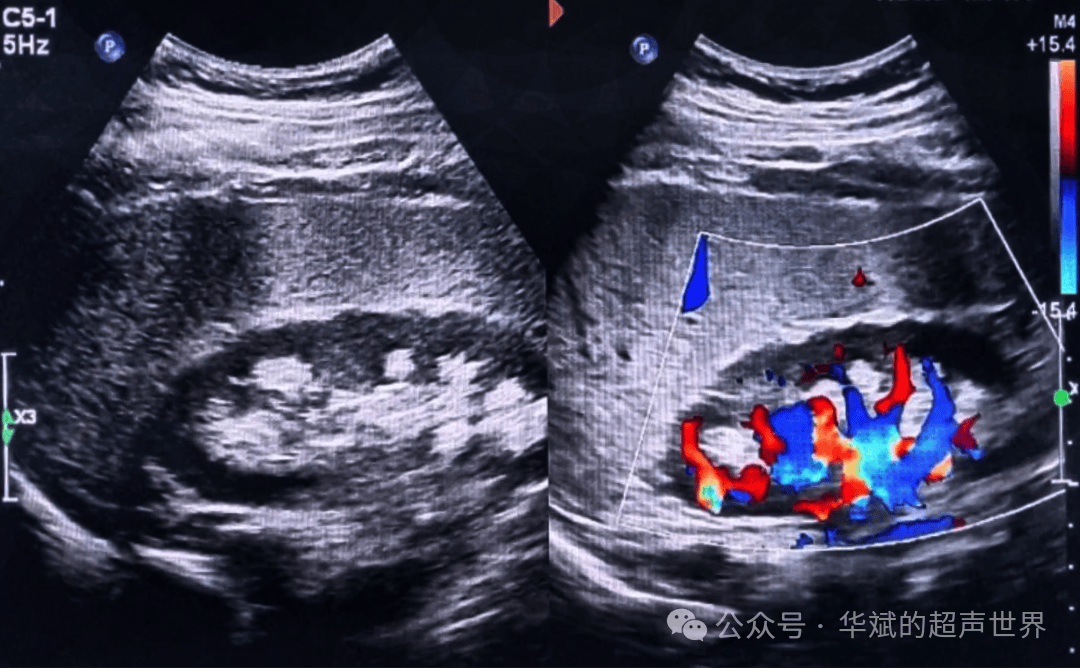 超声问答•肾内这种"花瓣"样分布的强回声是痛风肾吗?还是海绵肾?