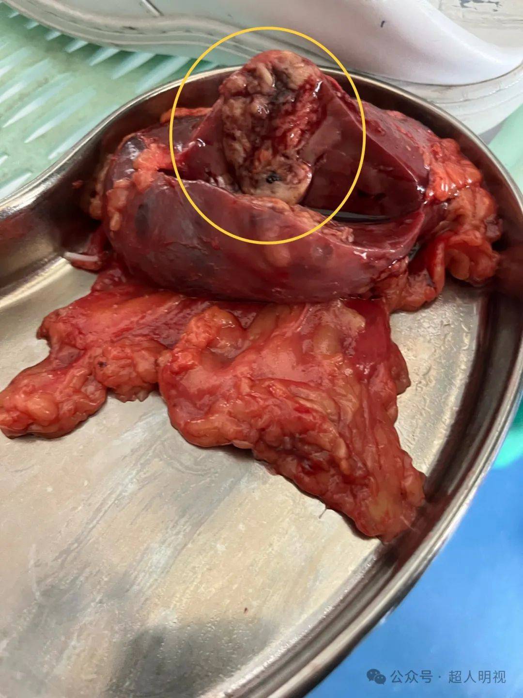 一个完整肾肿瘤病例