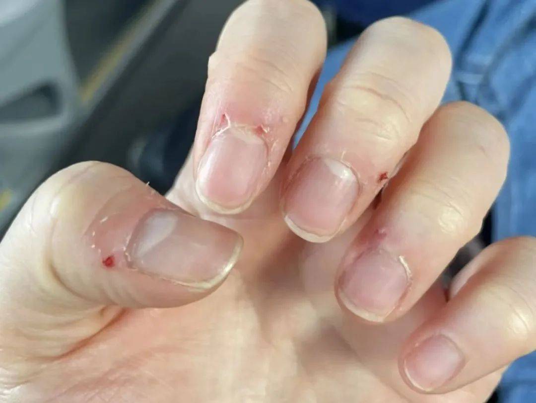 手上长倒刺是什么原因?倒刺和甲沟炎有什么关系