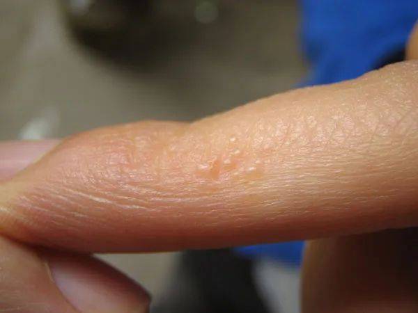 手上突然冒出透明"小水泡",还特别痒!