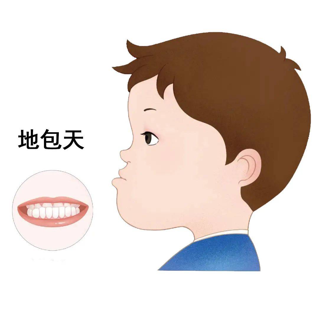 :下牙包住上牙,影响面型发育