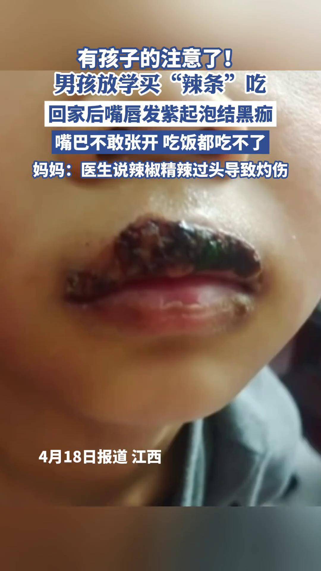 男孩吃"辣条"后,嘴唇发紫起泡结黑痂,嘴巴不敢张开吃饭都吃不了,妈妈