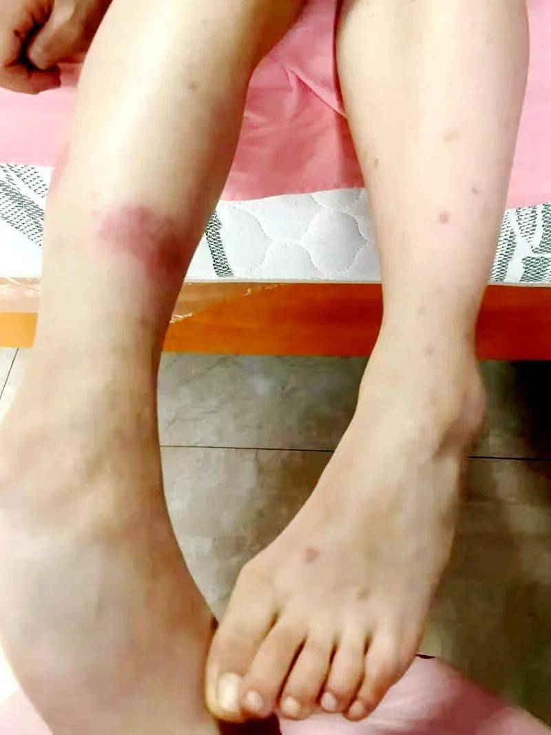 儿童血小板减少性紫癜:家长别慌,科学护理助