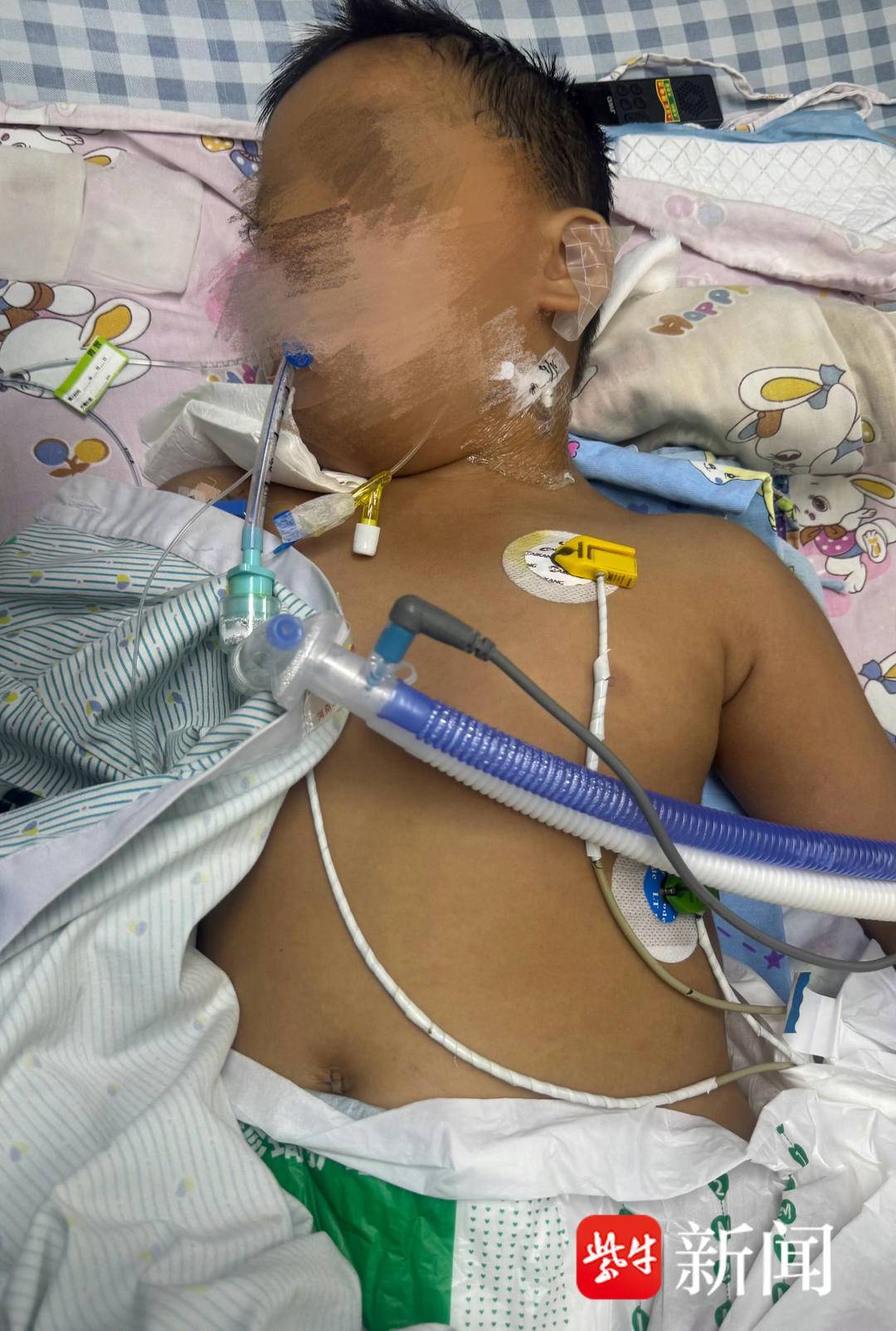 3岁男童因打呼噜入院做手术昏迷不醒 被初步诊断可能脑死亡(图1)