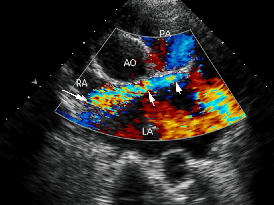 一文掌握:超声心动图必备基本功