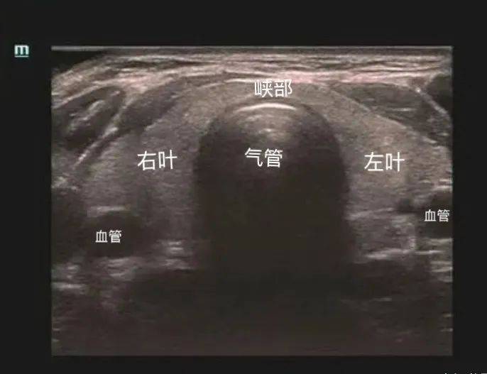 甲状腺超声报告解读