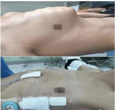 患者术前术后的胸壁对比胸廓畸形主要包括漏斗胸,鸡胸,扁平胸,桶状胸