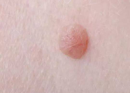 身上长出这种"肉疙瘩",说明什么问题?