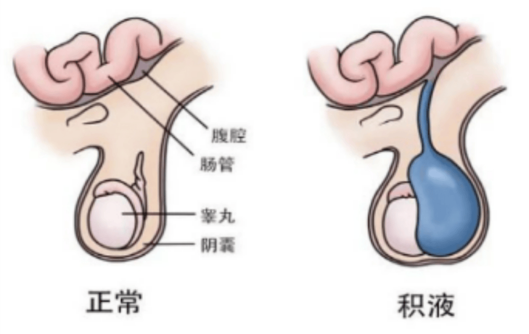 西盟县人民医院普外科成功为患儿实施睾丸鞘膜积液翻转术 包皮环切术