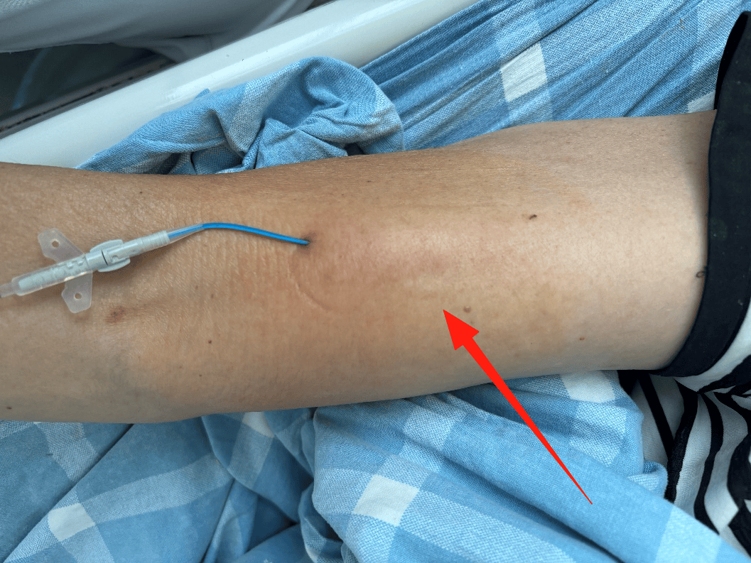 picc置管后出现红色条索这种静脉炎你可能没遇过