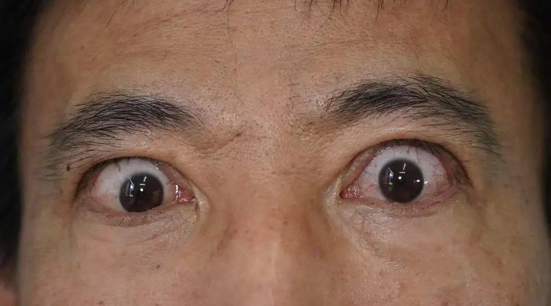 眼睛凸了,别只盯着眼科!