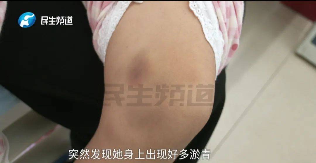 以为是磕伤有淤青5岁女童确诊白血病父亲落泪不会放弃想边打工边给