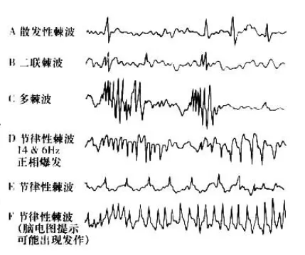 脑电图的 "正常" 与 "异常":波形特征及判断标准