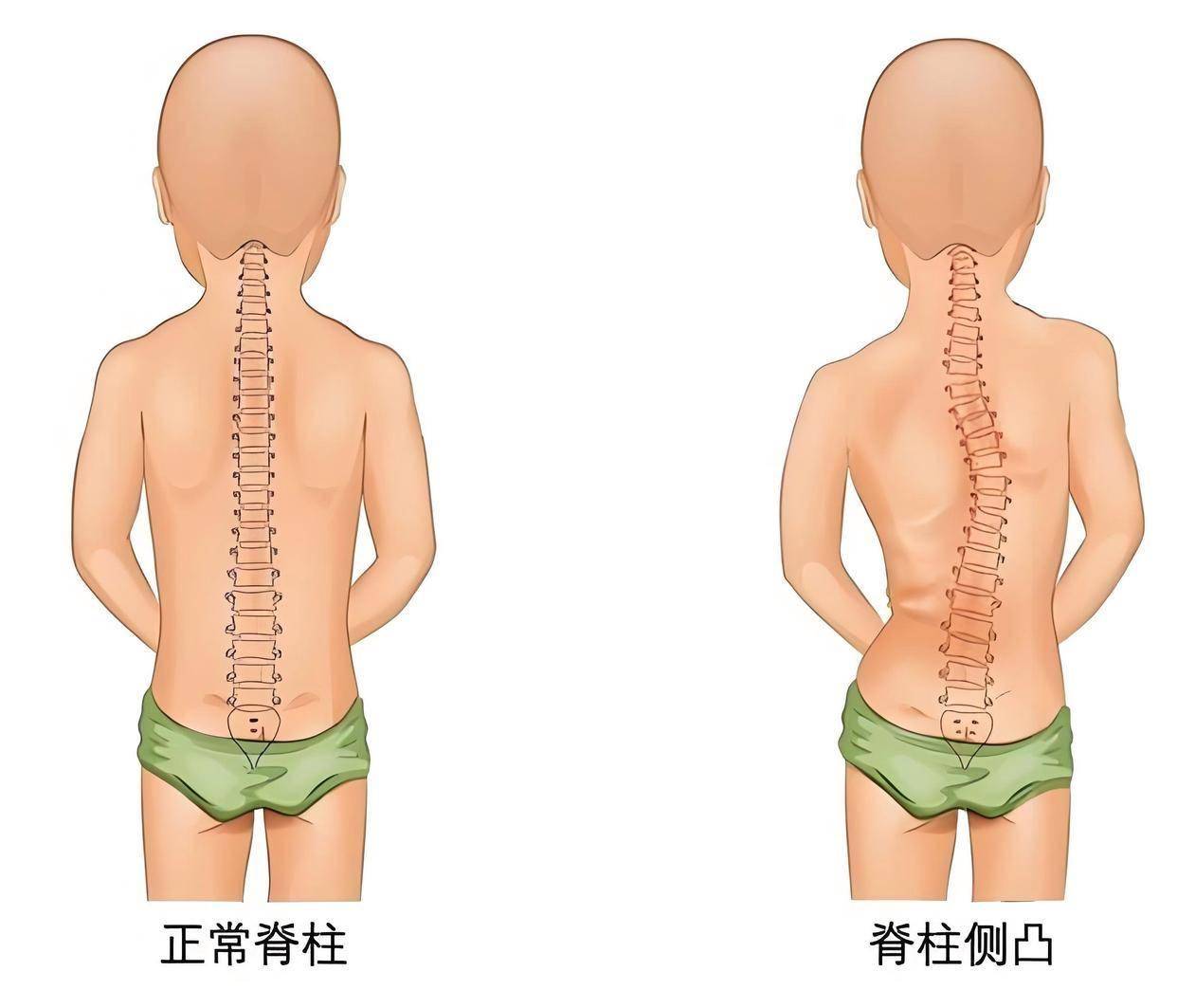 青少年脊柱侧弯:早期筛查与科学干预是关键