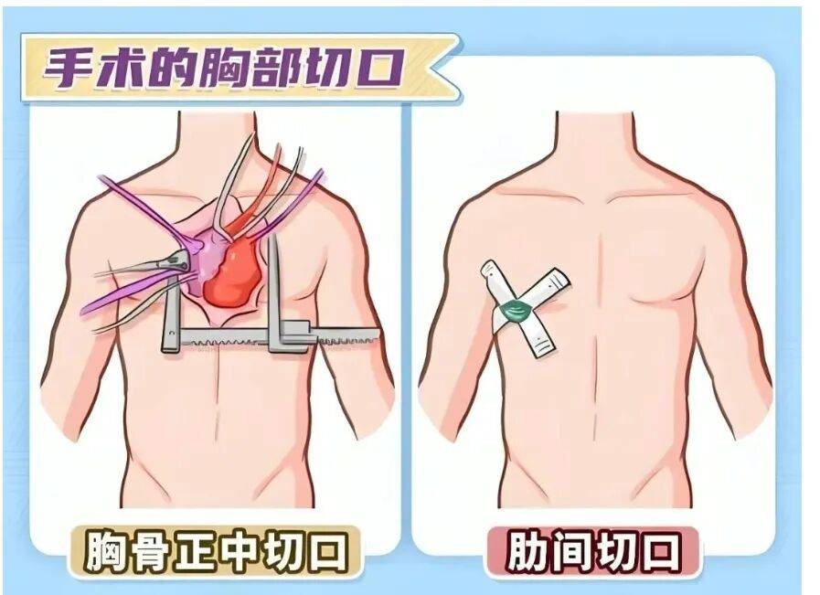 这类心脏病患者不用再怕"开胸"了